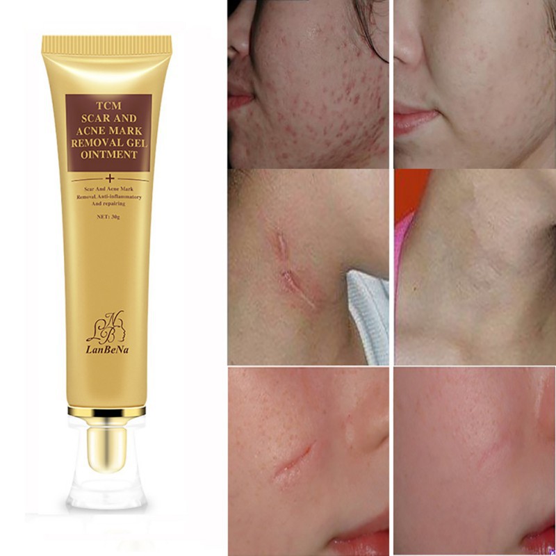 Scar Acnes Keloid Repairs Stretch Gel Cream Marks Skin Burns Removal 4235